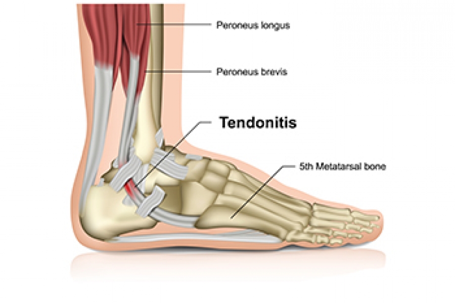 Achilles Tendonitis: Symptoms, Causes, Risk Factors – Clark Podiatry Center